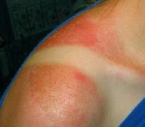 How to get rid of sunburn