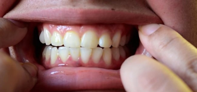 הלבנת שיניים בטוחה בבית