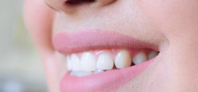 Safe teeth whitening at home