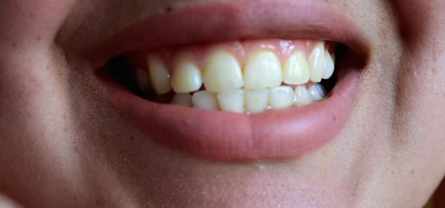 Albirea dinților în siguranță la domiciliu