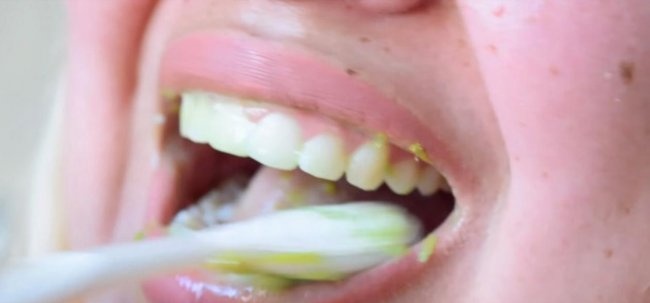 Albirea dinților în siguranță la domiciliu