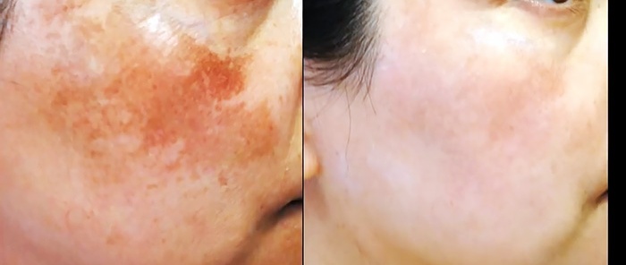 Neįtikėtinai paprastas būdas pašalinti pigmentines dėmes ant odos